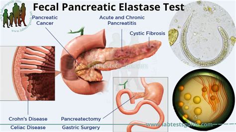 ELASTASE PANCREÁTICA